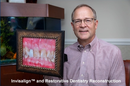 invisalign-gallery